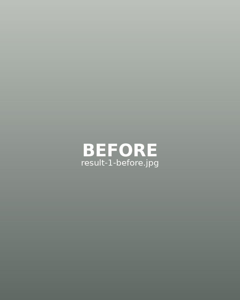 Before: Dermal Filler — Cheeks