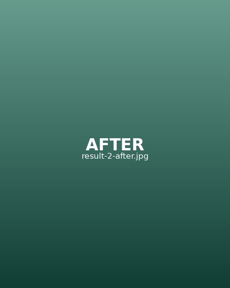 After: Profhilo — Full Face