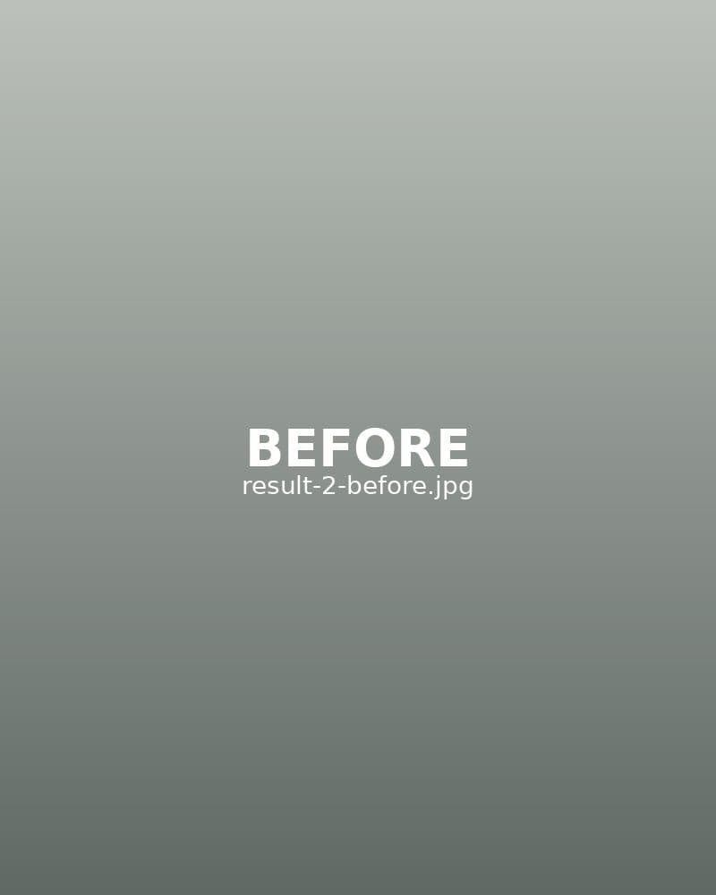 Before: Profhilo — Full Face