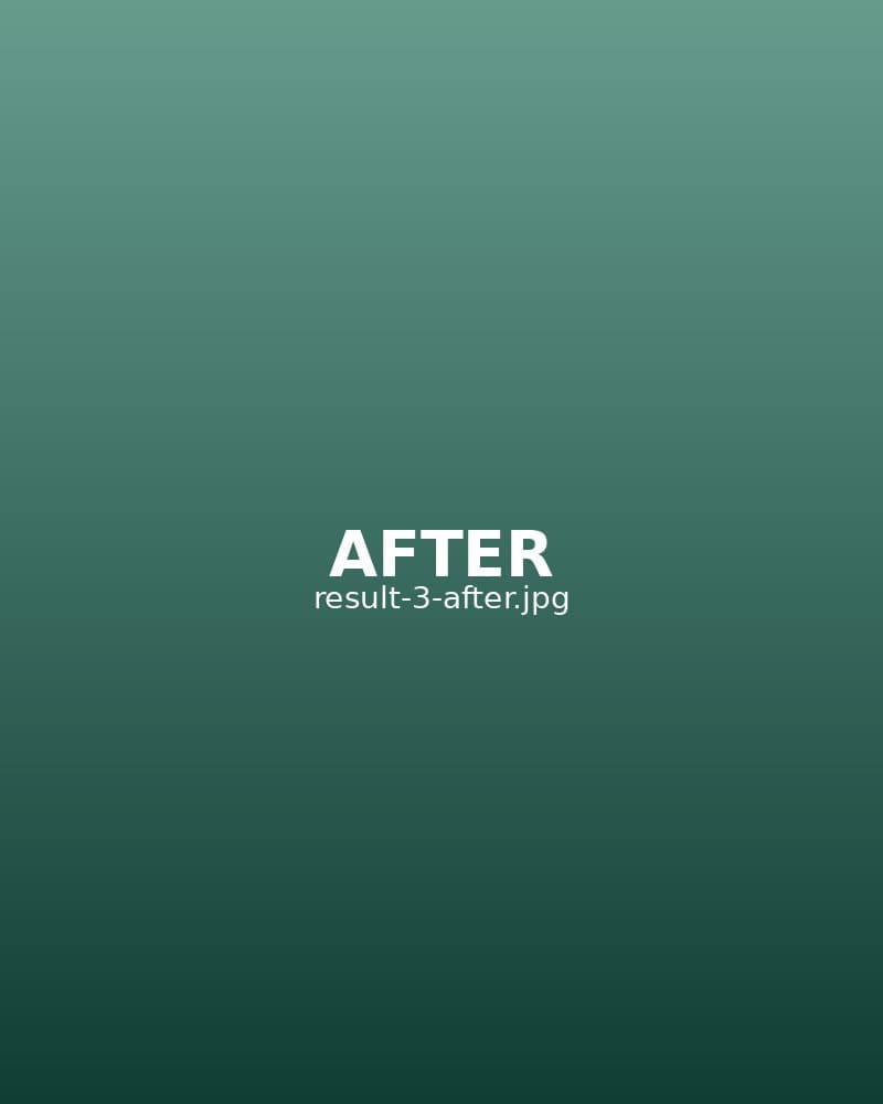 After: Anti-Wrinkle — Upper Face