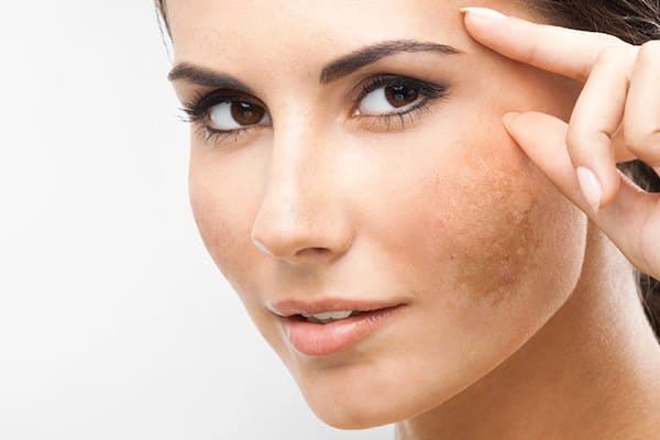 Pigmentation, Melasma & Acne Scars Removal