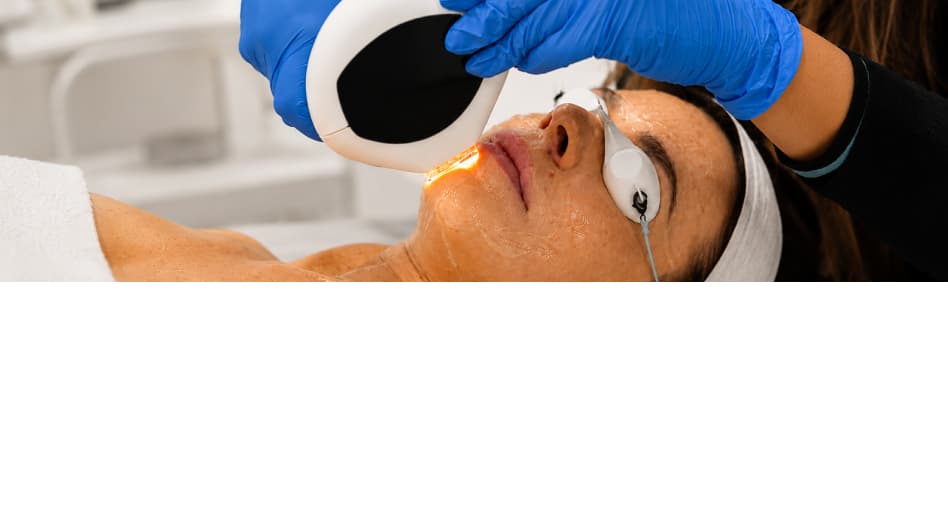 IPL Photofacial for Pigmentation & Sun Damage
