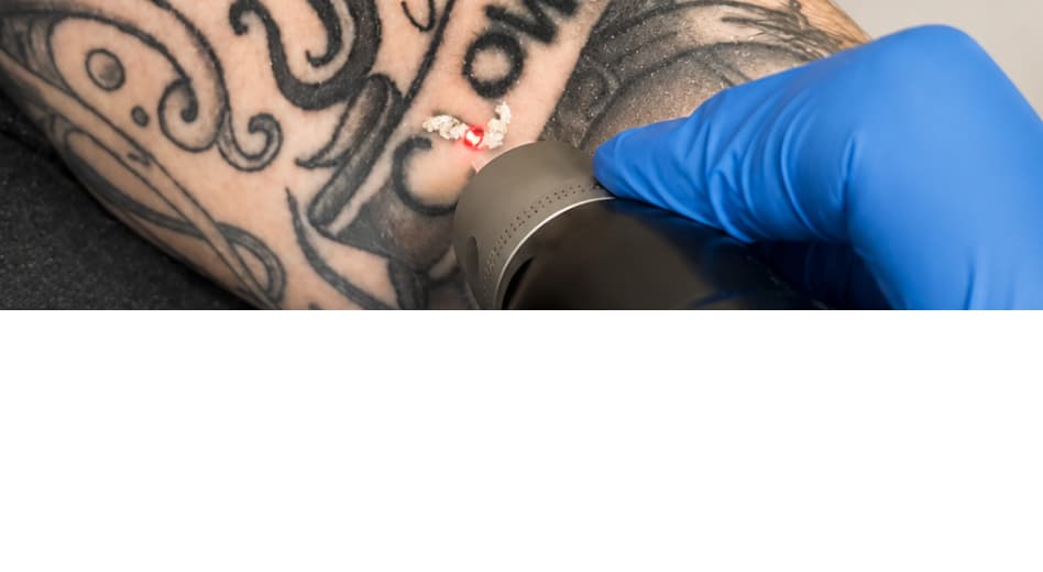 Laser Tattoo Removal